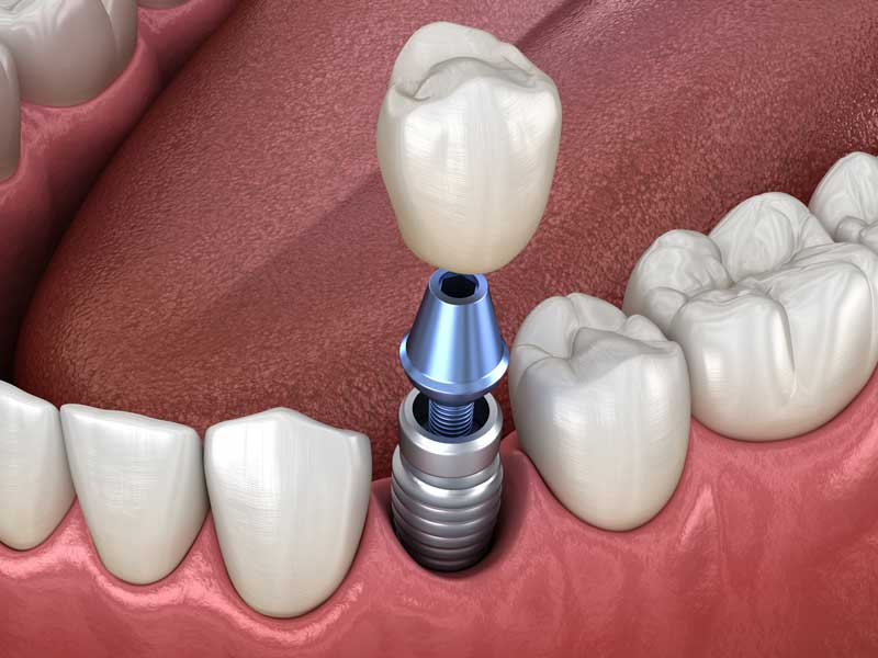 3D Dental Implant